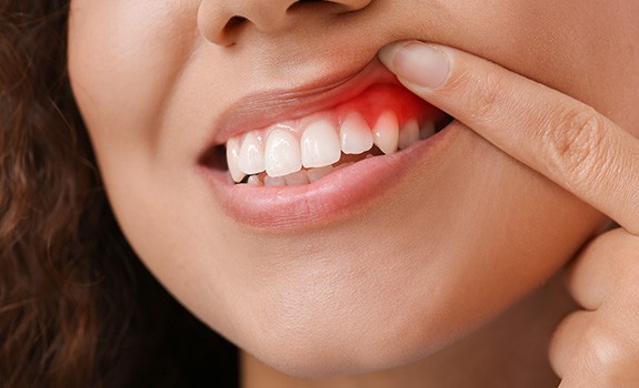 a woman holding up her lip to reveal inflamed gums